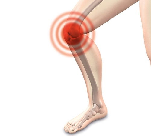 sindromul durerii de genunchi